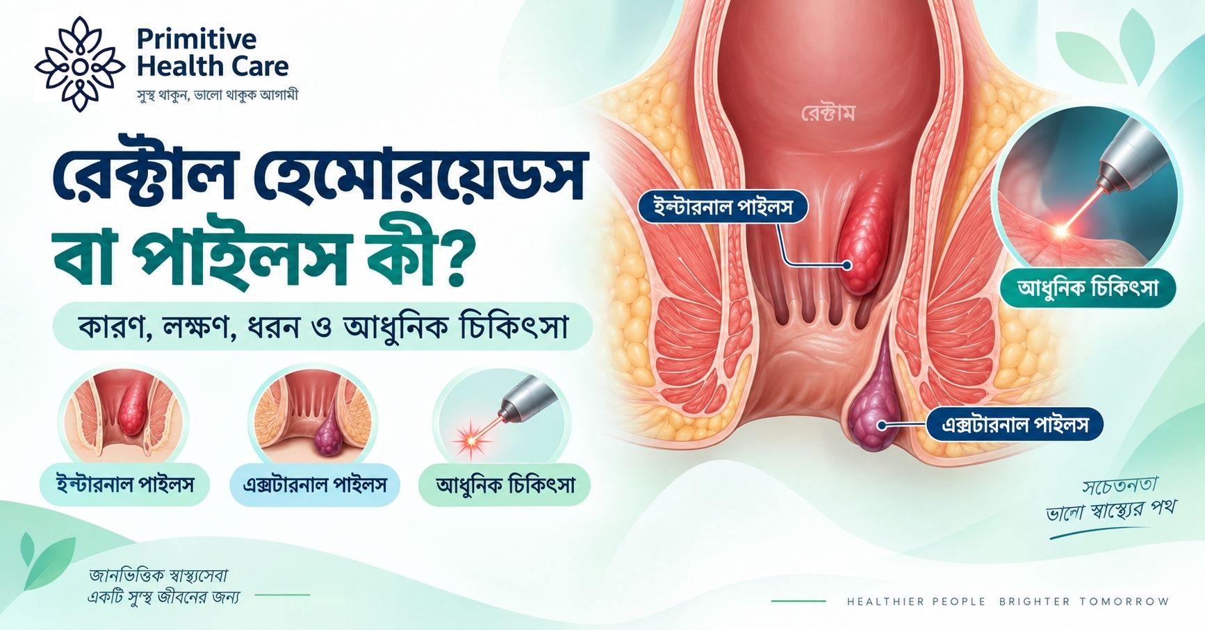 Rectal Hemorrhoids Piles Causes Symptomsty types Treatment